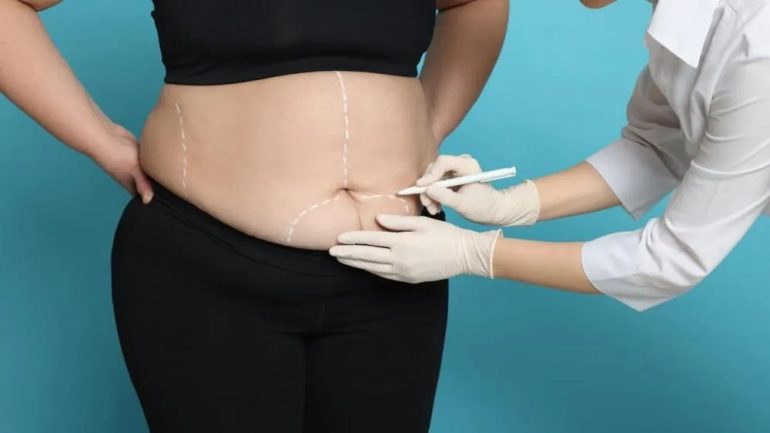 Especialista explica as principais mudanças nas regras da Cirurgia bariátrica e o que representam