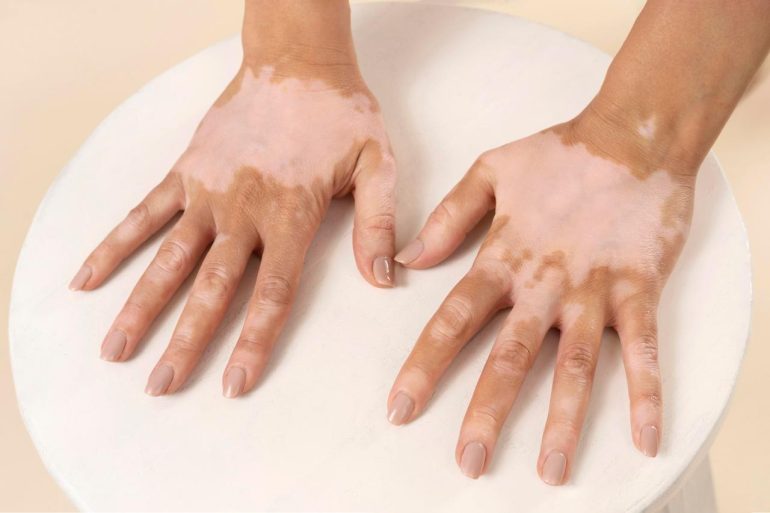 Vitiligo: condição atinge mais de 1 milhão de brasileiros e afeta autoestima, mas não oferece riscos à saúde