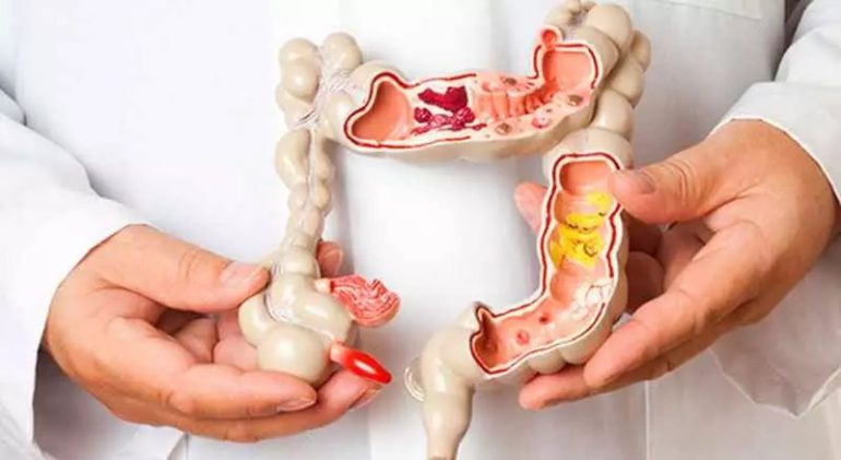Demanda por exames que detectam câncer colorretal cresce em ritmo lento, mostra levantamento