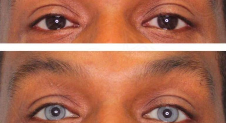 Oftalmologista alerta sobre perigos de procedimento para mudar cor dos olhos